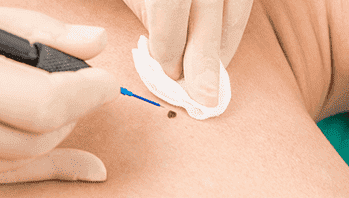 skin-cancer-removal